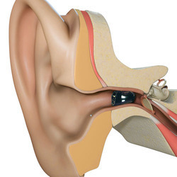Starkey SoundLens Synergy 1000 IIC Hearing Aid